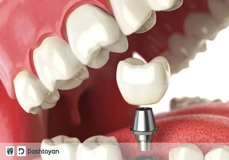 Dental implantology